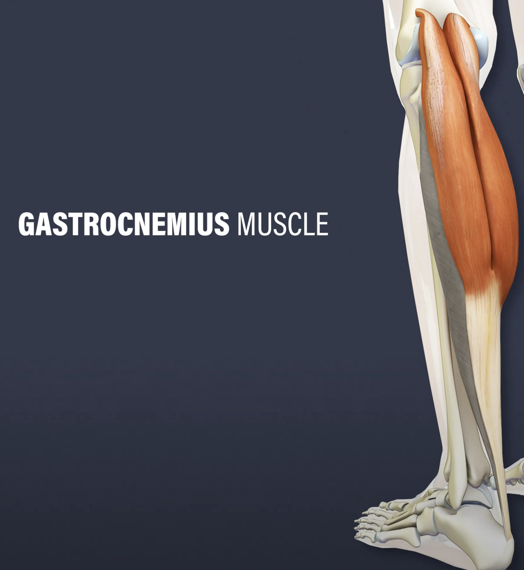 Bristning i gastrocnemius vadmuskel Bristning i gastrocnemius vadmuskel även kallat gubbvad