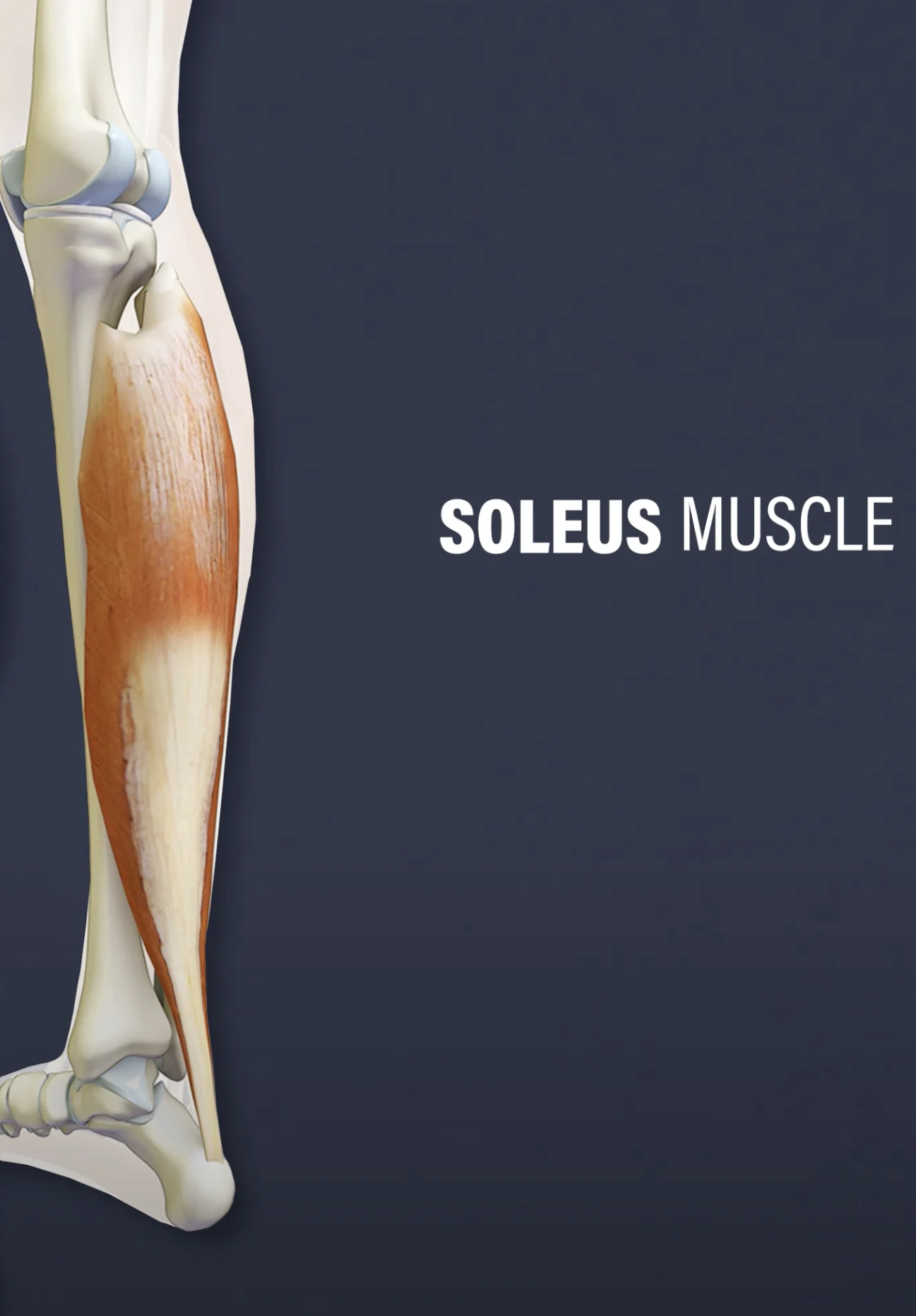 Bristning i soleus vadmuskel Bristning i soleus vadmuskel