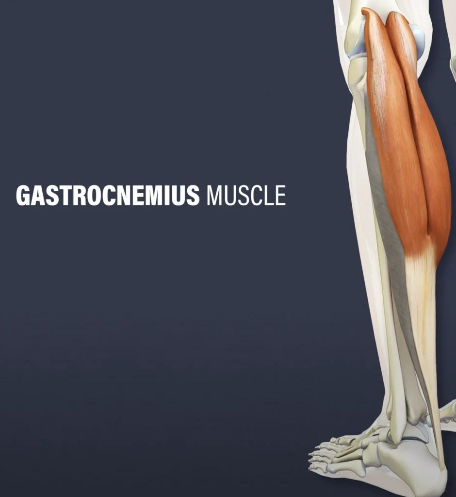Bristning i gastrocnemius vadmuskel även kallat gubbvad Bristning i gastrocnemius vadmuskel även kallat gubbvad